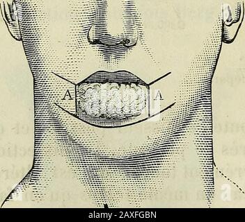 Manuel de médecine générale . FIG. 475.Procédé de Malffaisrne combiné avec celui de Camille Bernard. Quà la base de los maxillaire, et réunies là par incision trans-vente (fig. 475).dans le premier cas, sur aura une perte de substance triangou-. Banque D'Images