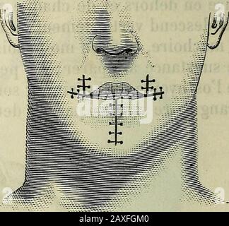 Manuel de médecine générale . FIG. 475.Procédé de Malffaisrne combiné avec celui de Camille Bernard. Quà la base de los maxillaire, et réunies là par incision trans-vente (fig. 475).dans le premier cas, sur aura une perte de substance triangou- Banque D'Images