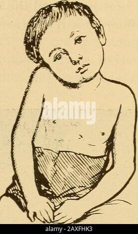 Conférences sur la chirurgie orthopédique . Fig. 11.—spondylite cervicale, avec tête torsadée et muscles sterno-mastoïdes contractés et prom-inents. 30. Fig. 12.—la spondylite cervicale; la tête courbée d'un côté et reposant sur l'épaule theraisée. Lorsqu'elle se produit, elle pointe généralement latéralement vers le dos du muscle sterno-mastoïde; elle peut pointer dans le pharynx.le pharynx, cependant, n'a pas besoin d'être examiné unlessecertains symptômes d'abcès à cet endroit. Soyez avant la formation de l'abcès du doigt dans la gorge Banque D'Images