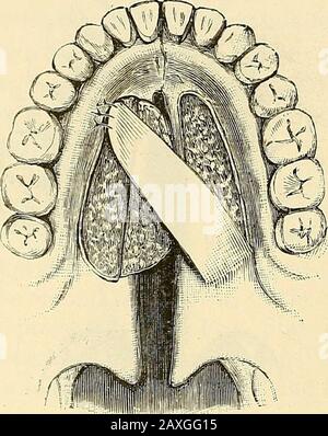 Un manuel de chirurgie opératoire . t un sixième d'un pouce externalyà sa marge. La plus grande partie de l'incision s'étend d'avant en arrière parallèle à la fente. Il doit commencer au niveau de l'extrémité antérieure de la fente et se terminer au dos du palais dur (d e, fig. 279). À ses extrémités antérieure et postérieure, cette incision doit être portée vers l'intérieur jusqu'à la marginale de la fente. Une framboise est maintenant insérée, et par elle le muco- périostéum interne à l'incisionest séparé de l'os asfar vers l'intérieur comme la marge de thecleft. Troisième étape.—le volet se madeà la deuxième étape de Banque D'Images