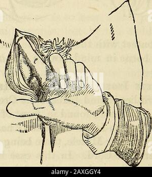 Conférences sur le système américain éclectique de chirurgie . WBBSem cou du sac à la recherche des restrictions, qui se trouvent généralyau ring interne; il peut toutefois être à la Fig. 137. N*. Anneau externe; ou il peut y avoir une sténose à chacun. La striction doit être dilatée pour admettre le doigt dans l'abdomen. Ceci est fait par ce qu'on appelle un bistouri à sonde, ou couteau asimilar, fait à cette fin, pas assez jusqu'au point, et seulement pour un espace court en dessous de lui (Fig. 138). La Fig. 138. Banque D'Images