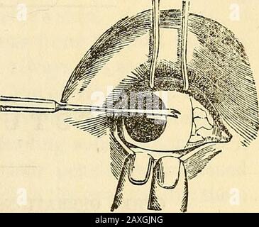 Conférences sur le système américain éclectique de chirurgie . CAUSE ET CORRECTION DE L'ONCTION. 729 Fig. 125.. Ardemment comme Fig. 120) est attelé à la conjonctive, environ à mi-chemin entre la marge de la cornée et la can interne-ainsi, le ballon puis roulé vers l'extérieur par elle, et la poignée givento un assistant, par qui il est fermement maintenu dans la même potion. Le chirurgien soulève ensuite la conjonctive avec des pinces à crochet fin (Fig. 118), et découpe par pendance avec des ciseaux curvedciseaux (Fig. 119), et continuesto l'élever et diviser le cellulartissu jusqu'à ce qu'il atteigne le muscle, qui lui aussi sévote Banque D'Images