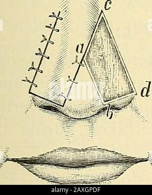 Un manuel de chirurgie opératoire . f Le Côté Opposé (opération Langenbecks).— la forme la plus pratique pour donner le défaut est un quadrilatère. De l'angle supérieur et intérieur de l'anincision défectueuse (a b, Fig. 254) est transporté vers le bas le dorsum du nez, presque jusqu'au sommet du côté du son. Une deuxième incision(c d) est faite, parallèle au premier, et des runsdu juste en dessous du canthus intérieur à la jonction de l'ala avec la joue. Les extrémités plus profondes des deux incisions sont unitedpar une troisième coupe (b d), qui s'étend juste à la frontière libre de l'ala. Le quadrilatère ainsi marqué dehors est Banque D'Images