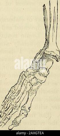 Conférences sur le système éclectique américain de chirurgie . et accompagné d'une dislocation partielle ou entière de l'ankleLe déformity résultant est considérable : le malleolus interne Fig. 93* Fig. 94*. Banque D'Images