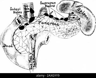 Un manuel d'anatomie . partie de l'iléon, du cecum, de l'appendice et du côlon ascendant et vider la lymphe dans les mésentéricnodes supérieurs. (C) les nœuds mésocoliques (faisant partie de la chaîne paracolique) sont des chiffres et il est en relation avec le côlon transverse. La lymphe du système VASCULAIRE LYMPHATIQUE 264 traverse le côlon à travers ces nœuds et la thence jusqu'aux nœuds mésentériques supérieures. Du groupe mésentérique supérieur la lymphe est drainée par le tronc mésentérique supérieur qui aide à former le tronc intestinal commun. 3. Le groupe mésentérique inférieur hes à l'origine de l'artère inferormesentérique. Banque D'Images