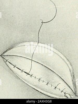 Annales de chirurgie . Fig. 7.—rétablissement de la paroi postérieure du canal inguinal. Banque D'Images