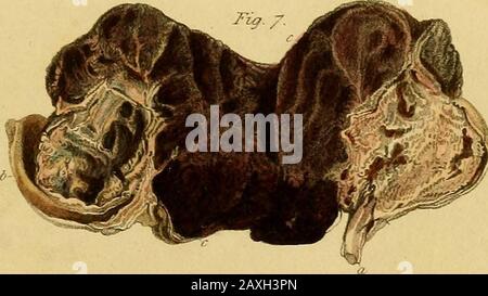 Conférences sur la chirurgie opératoire de l'œil, ou, une enquête historique et critique sur les méthodes recommandées pour le traitement de la cataracte pour la formation d'un élève artificiel, &c&c: contenant une nouvelle méthode d'exploitation de la cataracte par extraction, qui élimine toutes les difficultés jusqu'à présent de cette opération : étant la substance de cette partie du cours de l'auteur des conférences sur les principes et la pratique de la chirurgie qui se rapporte aux opérations sur cet organe . ?. JC„&lt;/,MS/u,/j/aj. Jasy. Iy Bur^s &231.5S.peu de WadmiS, Stnet. TRAVAILLE PAR M. GUTHRIE. OBSERVATIONS SUR TIR DE CANON Banque D'Images