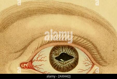 Conférences sur la chirurgie opératoire de l'œil, ou, une enquête historique et critique sur les méthodes recommandées pour le traitement de la cataracte pour la formation d'un élève artificiel, &c&c: contenant une nouvelle méthode d'exploitation de la cataracte par extraction, qui élimine toutes les difficultés jusqu'à présent de cette opération : étant la substance de cette partie du cours de l'auteur des conférences sur les principes et la pratique de la chirurgie qui se rapporte aux opérations sur cet organe . ? Banque D'Images