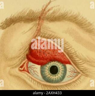 Conférences sur la chirurgie opératoire de l'œil, ou, une enquête historique et critique sur les méthodes recommandées pour le traitement de la cataracte pour la formation d'un élève artificiel, &c&c: contenant une nouvelle méthode d'exploitation de la cataracte par extraction, qui élimine toutes les difficultés jusqu'à présent de cette opération : étant la substance de cette partie du cours de l'auteur des conférences sur les principes et la pratique de la chirurgie qui se rapporte aux opérations sur cet organe . Banque D'Images