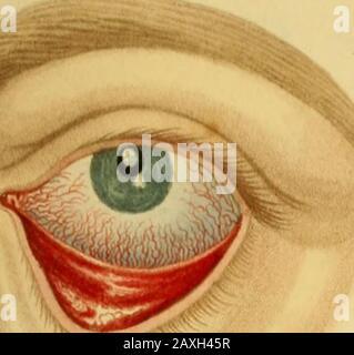 Conférences sur la chirurgie opératoire de l'œil, ou, une enquête historique et critique sur les méthodes recommandées pour le traitement de la cataracte pour la formation d'un élève artificiel, &c&c: contenant une nouvelle méthode d'exploitation de la cataracte par extraction, qui élimine toutes les difficultés jusqu'à présent qui accompagnent cette opération : étant la substance de cette partie du cours des conférences de l'auteur sur les principes et la pratique de la chirurgie qui se rapporte aux opérations sur cet organe . ketch montre le couteau d'acier gardée par la lame de silverblade, qui se projette au-delà de lui. Fig. 2. La lame en acier décache Banque D'Images