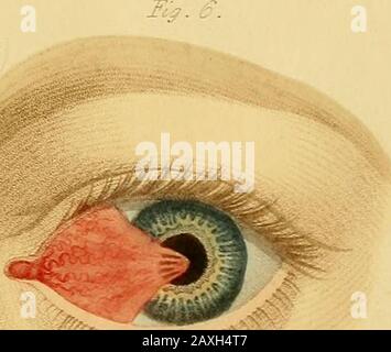 Conférences sur la chirurgie opératoire de l'œil, ou, une enquête historique et critique sur les méthodes recommandées pour le traitement de la cataracte pour la formation d'un élève artificiel, &c&c: contenant une nouvelle méthode d'exploitation de la cataracte par extraction, qui élimine toutes les difficultés jusqu'à présent de cette opération : étant la substance de cette partie du cours de l'auteur des conférences sur les principes et la pratique de la chirurgie qui se rapporte aux opérations sur cet organe . ? Don.,Iuili. OrWindmiZ Strtet. Fiy.9, Flatt 3. Pi?- /- Banque D'Images