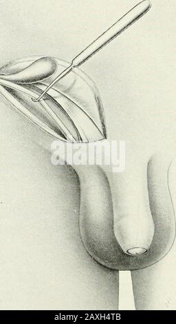 Annales de chirurgie . Fig. 2.—Rabat retourné, montrant l'aponeurosis de l'ol)lique externe, de l'extérieur et du cordon lorsqu'il passe sur l'os pubique. Fig. 3.-canal Inguinal ouvert de l'anneau externe à l'anneau intérieur, sac de douche et cordon isolé. Banque D'Images