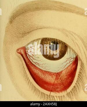 Conférences sur la chirurgie opératoire de l'œil, ou, une enquête historique et critique sur les méthodes recommandées pour le traitement de la cataracte pour la formation d'un élève artificiel, &c&c: contenant une nouvelle méthode d'exploitation de la cataracte par extraction, qui élimine toutes les difficultés jusqu'à présent de cette opération : étant la substance de cette partie du cours de l'auteur des conférences sur les principes et la pratique de la chirurgie qui se rapporte aux opérations sur cet organe . Banque D'Images