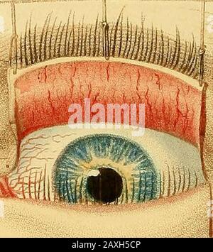 Conférences sur la chirurgie opératoire de l'œil, ou, une enquête historique et critique sur les méthodes recommandées pour le traitement de la cataracte pour la formation d'un élève artificiel, &c&c: contenant une nouvelle méthode d'exploitation de la cataracte par extraction, qui élimine toutes les difficultés jusqu'à présent de cette opération : étant la substance de cette partie du cours de l'auteur des conférences sur les principes et la pratique de la chirurgie qui se rapporte aux opérations sur cet organe . L'opération qui est appelée sclero-titectomia par les Allemands, a été fait le sujet de l'atreatise à Tubinge Banque D'Images