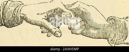 Conférences sur le système éclectique américain de chirurgie . l'autre, puis faire l'extension (comme il est représenté faire, avec l'ancien expédient dans la coupe, fig. 47), alors que le joint est légèrement fléchi, et les pièces retrouveront très facilement leur Fig. 47.. lieu, à moins que le temps considérable se soit écoulé depuis la survenue de l'accident. Dans un tel cas, la prolongation doit être maintenue pendant un certain temps et doit être tentée avec persévérance avant que le cas ne soit abandonné. Pour cela, lorsque beaucoup de force doit être utilisée et maintenue pendant longtemps, l'apièce de ruban doit être fixée au doigt par le clou de girofle Banque D'Images