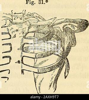 Conférences sur le système américain éclectique de chirurgie . Le déplacement de l'épaule, cependant, donne au patient beaucoup de douleur, et c'est avec beaucoup de difficulté qu'il peut le déplacer à tout.L'épaule semble quelque peu aplatie, surtout si le patientbe mince dans la chair — dans ce cas il n'y aura aucune difficulté à inreconnaître la nature de la blessure à première vue. Mais chez les individus verycharny le diagnostic est parfois assisté avec l'incertitude con-sidérable. Le patient se plaint de peu d'excuses lorsqu'il tente de déplacer l'épaule. La cause de cet accident est généralement une force appliquée sur l'épaule Banque D'Images