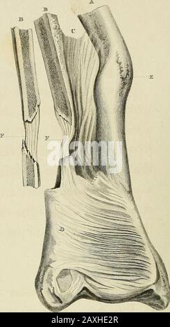 Un traité sur les dislocations et sur les fractures des articulations . Fig. 2 Banque D'Images