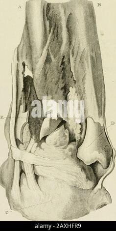 Un traité sur les dislocations et sur les fractures des articulations . Banque D'Images