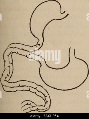 Chicago journal médical et examinateur . onlyone présent. Le stomachis droit plus petit, pyriforme en forme, hid-den derrière le foie, se trouve veryobliquement, avec son pylorus point-ing vers le pylorus de l'autre. Son duodénum se joint une fois le duodénum gauche, et les entrailles de thetwo apparaissent fusionnées pour un sixième de leur longueur d'onde; une rainure longiitud-inale bien marquée marque donc le fusedentrel que l'apparence d'un pistolet à double barré est produite ; la section transversale montre que le théyare divisé par un septum membraneux en deux canaux distincts, qui communiquent librement entre eux par une ouverture fréquente Banque D'Images