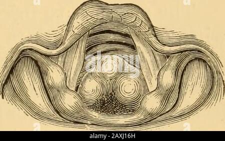 Maladies de la gorge et des voies nasales; un guide pour le diagnostic et le traitement des affections du pharynx, du sophage, de la trachée, du larynx et des nares . une parthie a été produite par le pencilingthe larynx, d'abord avec le chloroforme, Et puis subse- FLG- m Tl!mor °f, la trachée J (Schroetter). Quente, à des intervalles d'environ une heure, avec une solution de l'acétate de morphia— 10 grains à la drachme de l'eau.2 Portionsde la tumeur ont été enlevés avec des forceps à plusieurs reprises, et finalement la portion restante a été injectée avec une solution du sesquichloride de fer, twoparts à l'une de l'eau, qui prod Banque D'Images