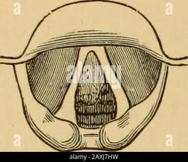 Maladies de la gorge et des voies nasales; un guide pour le diagnostic et le traitement des affections du pharynx, des sophages, de la trachée, du larynx et des nares . ou un an ou ainsi, avec dyspnée. Les ventricularbands étaient très épais et hypertrophiés, les vrais cordeaux étaient à peine vus, et la tumeur apopillomateuse de la taille d'une petite cerise, ou un très grand pois, occupiedla paroi postérieure du larynx sous le pli inter-arytéroïdal (Fig. 150). La Thégrowth a été enlevée par l'évision avec les pinces antéro-postérieures de Mackennies, avec un soulagement rapide de la dyspnée et une restauration progressive de la voix. Lorsqu'une croissance est pedu Banque D'Images