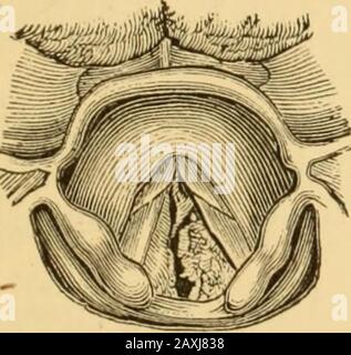 Maladies de la gorge et des voies nasales; un guide pour le diagnostic et le traitement des affections du pharynx, des sophages, de la trachée, du larynx et des nares . -•V Fig. 148.—Durhams forceps flexibles. Bobine spiralée flexible de fil,1 qui permet l'expansion des lames de la forceps, ou qui les dépasse selon les poignées séparées ou approxées. Itsflexibilité permet de plier l'instrument à la forme souhaitée (Fig. 148). Les pièces en contact qui n'offrent aucune résistance à l'introduction de l'instrument sont admirablement adaptées pour une utilisation dans le larynx, le pharynx ou les passages nasaux. Banque D'Images