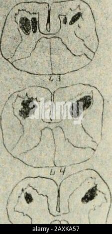 Le Journal des maladies nerveuses et mentales . ^. ;- * 1 U#s Fig. I. Les parties grisées représentent les zones de destruction dans la matière grise. Dessiné au moyen d'appareils de projection Edinger photographiés et photographiés, étaient le bleu de méthylène de Nissls, l'hématoxyline et l'éosine, la tache de fibres médullées de Weiguts, la méthode de coloration des neuroglies de Weiguts et de Marchis pour les fibres dégénérées. Tous les segments DE LA POLIOMYÉLITE ANTÉRIEURE AIGUË 549 ont été largement impliqués et, afin d'éviter la répétition, les niveaux caractéristiques dans les segments cervical, dorsal et lombaire Banque D'Images