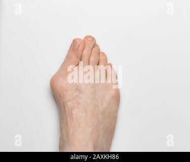 Gros plan du pied gauche droit avec Bunion, hallux valgus, sur le gros orteil causant une déformation Banque D'Images