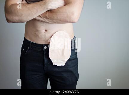 Vue avant sur le sac de colostomie attaché à l'homme patient, thème médical. Gros plan de la poche d'ostomie couleur de la peau. Traitement chirurgical du cancer du colon. Espace de copie. Banque D'Images