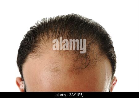 Homme qui perd des cheveux Banque D'Images