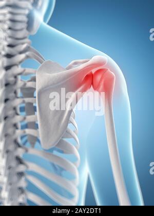 L'inflammation de l'épaule Banque D'Images