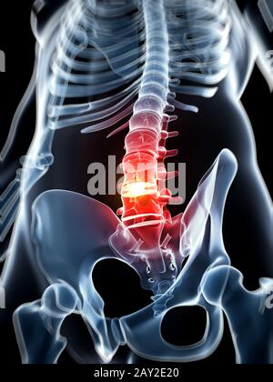 Rendu 3d illustration - hernie discale Banque D'Images