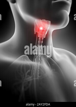 Rendu 3d illustration de l'inflammation de la glande thyroïde Banque D'Images