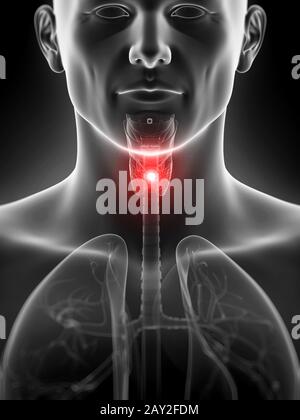 Rendu 3d illustration de l'inflammation de la glande thyroïde Banque D'Images