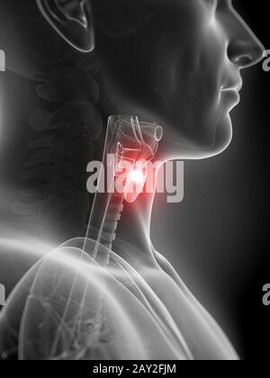 Rendu 3d illustration de l'inflammation de la glande thyroïde Banque D'Images