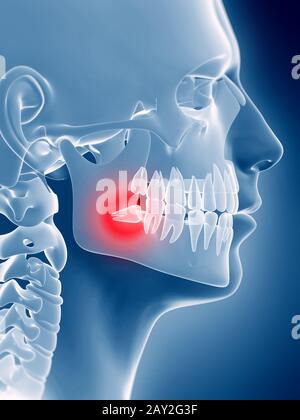 Rendu 3d illustration d'une dent de sagesse Banque D'Images