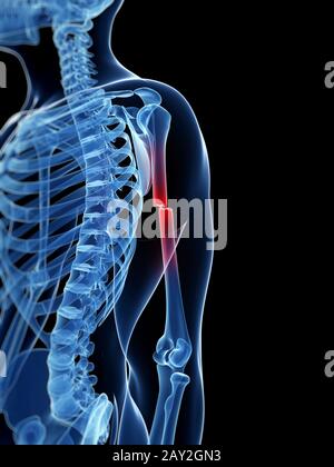 Illustration médicale d'un os du bras de borken Banque D'Images