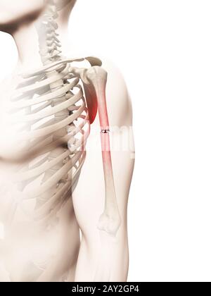 Illustration médicale d'un os du bras de borken Banque D'Images