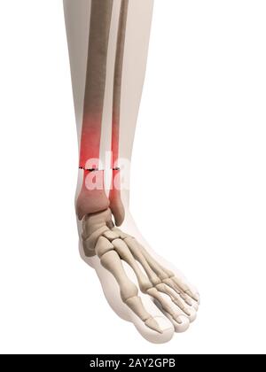 Illustration médicale d'une jambe cassée bone Banque D'Images