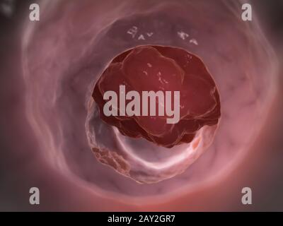 Rendu 3d illustration d'une tumeur du colon Banque D'Images