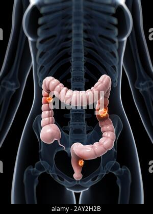 Rendu 3d illustration de cancer du colon Banque D'Images