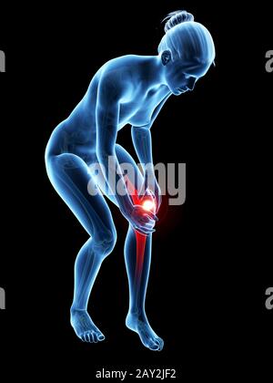 illustration médicale - femme souffrant de douleurs au genou Banque D'Images