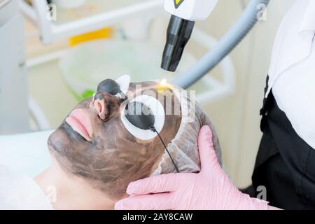 Procédure de décollement du visage en carbone gros plan. Les impulsions laser nettoie la peau du visage. Traitement de cosmologie matérielle. Processus de photothe Banque D'Images