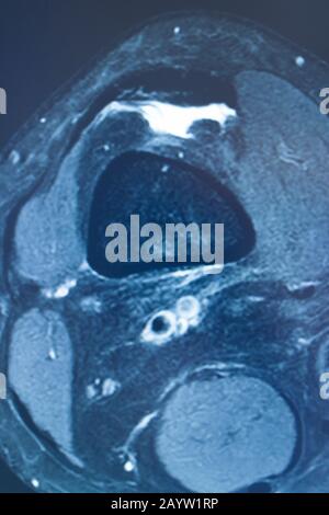 Blessures sportives du genou de grade 2 mcl IRM imagerie par résonance magnétique détachable traumatologie orthopédique scan. Banque D'Images