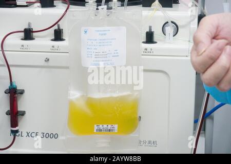 Wuhan, Chine. 17 février 2020. (200217) -- WUHAN, le 17 février 2020 (Xinhua) -- Un Plasma Donné d'un patient de coronavirus récupéré est vu au Wuhan Blood Centre à Wuhan, capitale de la province de Hubei en Chine centrale, le 17 février 2020. Les patients guéris qui ont été infectés par COVID-19 sont appelés à donner du plasma comme les premiers résultats ont indiqué l'efficacité des produits thérapeutiques dérivés du plasma convalescent dans le traitement des patients infectés dans des conditions sévères et critiques. Crédit: Xinhua/Alay Live News Banque D'Images