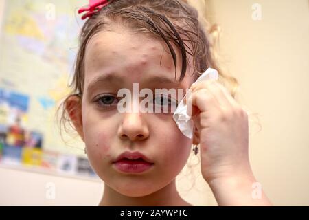 Portrait d'enfant triste fille avec des virus a la varicelle, la rougeole, la varicelle, la rubéole sur tout le corps. Maladies virales Banque D'Images