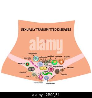 Infections virales et bactériennes. Maladies sexuellement transmissibles. Infographies. Illustration vectorielle sur un arrière-plan isolé. Illustration de Vecteur
