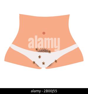 Maladies parasitaires de la phthiriase. Pubis de pédiculose. Structure des poux pubiens. Maladies sexuellement transmissibles. Infographies. Illustration vectorielle activée Illustration de Vecteur