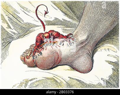 Le gout (également connu sous le nom de podagra quand il implique le gros orteil) est habituellement caractérisé par des attaques récurrentes de l'arthrite inflammatoire, un joint rouge, tendre, chaud, et gonflé. La douleur survient généralement rapidement en moins de douze heures. Le joint à la base du gros orteil est affecté dans environ la moitié des cas. Il peut également entraîner des tophi, des calculs rénaux ou une néphropathie urate. James Gillray (13 août 1756 ou 1757 – 1er juin 1815) était caricaturiste et créateur d'impression anglais célèbre pour ses satire politiques et sociaux gravés, principalement publiés entre 1792 et 1810. Banque D'Images