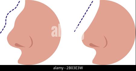 Nez avant et après correction de rhinoplastie isolé sur fond blanc. Comparaison du nez femelle après une chirurgie plastique. Illustration vectorielle d'un Illustration de Vecteur